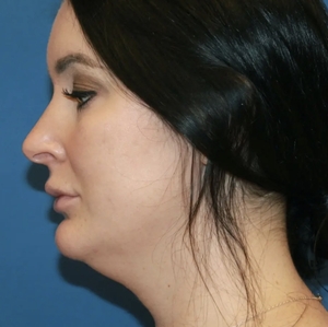 Lipo w Renuvion Face #1 (left)-before