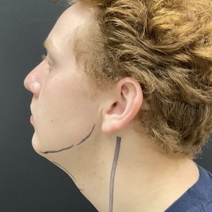 Lipo w Skin Tightening Face #6-before