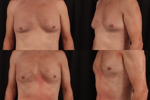 Male chest LAL w/ glandular excision-before