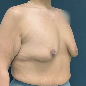 Breast Augmentation #23 435 cc-before