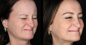 chotox - 20u gl, 10 u fh, 24u CF, 6u lips, 6u mentalis-before