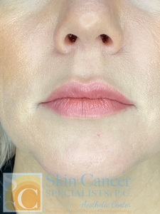 lip filler-before