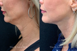 1 month post op MyEllevate, Morpheus8, and Sculptra x2 Vials-before