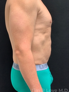 Abdominoplasty - Mini-after