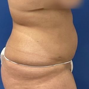Lipo w Renuvion #2-after