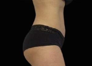 Emsculpt NEO #7-after