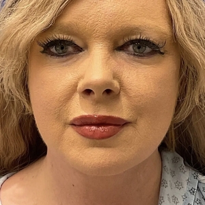 Lipo w Renuvion Face #2 (front)-after