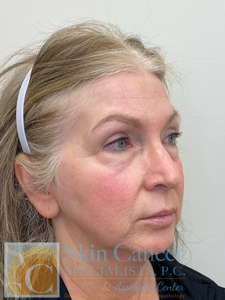 Filler and Threads-before