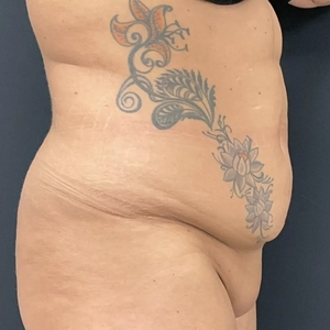 Tummy Tuck #10-before