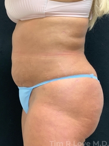 52 year old, 5'2 150lbs, 1 mo post op-after