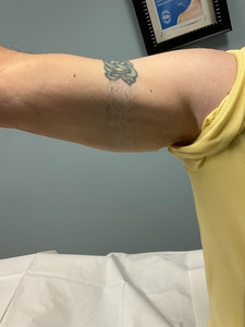 Tatto rmoval arm After-before