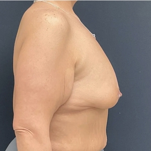Breast Lift #14 (right)-before