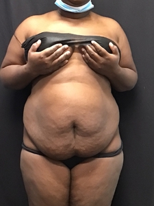 Lipo 360 + mini tummy tuck-before