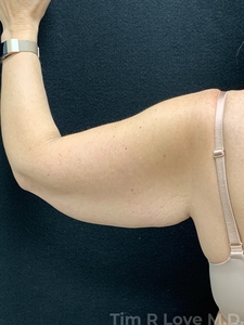 Brachioplasty-before