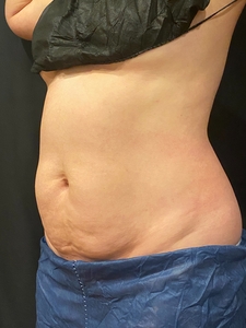 7 Weeks Post 1st CoolSculpting Treatment-after