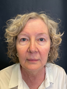 NECK AND LOWER FACE-after