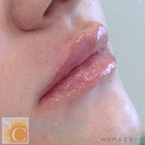 Lip Filler -after