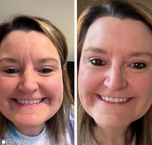 Botox-before