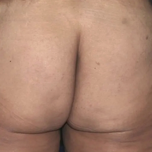 Cellulite Reduction #4-after