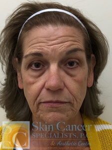 Sculptra and Botox-before