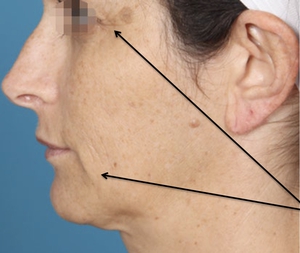 Skin Texture and Laxity-before