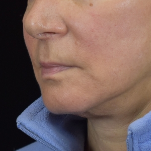 Marionette Lines-after