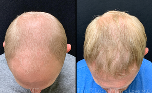 3000 grafts-before