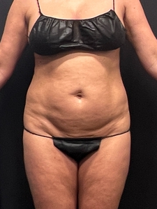 LAL upper+ lower abdomen + mini tummy tuck-before