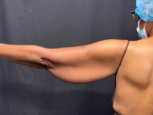 Brachioplasty-before