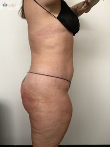 2 Butt Lift Treatments-after