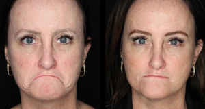 chotox - 20u gl, 10 u fh, 24u CF, 6u lips, 6u mentalis-before