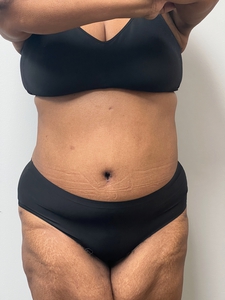 Tummy Tuck-before