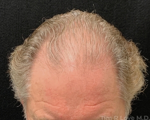Hair Transplant-before