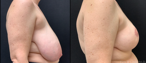 2 months PO-before