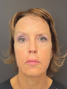 11 months post Morpheus8/Nanofat x3, Sculptra, 1 syringe Versa filler-after