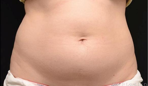 Liposuction - Abdomen-before