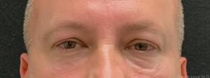 1 month post upper blepharoplasty-before