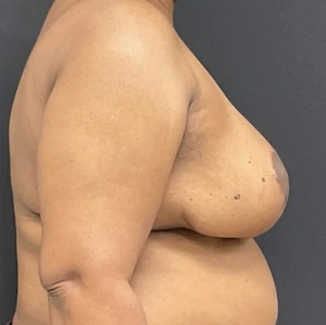 Breast Reduction #5-after