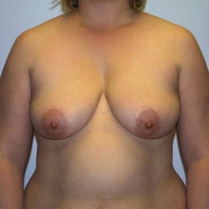 Breast Lift #7-before