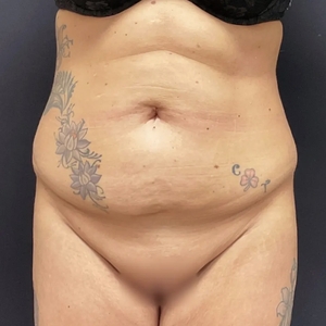 Mommy Makeover #10-before