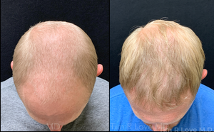 6mo post procedure, 3000 grafts-before