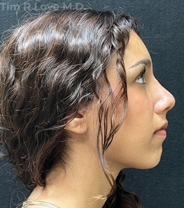 1 month post op-after