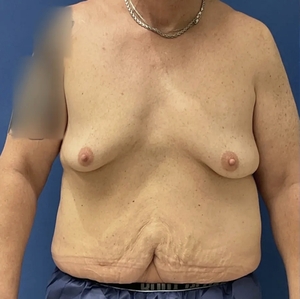 Male Breast Reduction #6-before