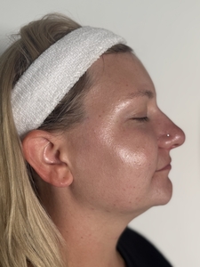 Before and After Side Profile Fire and Ice Facial-after