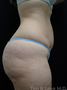 BodyTite - Abdomen-after