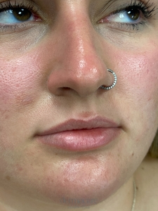 Whitney Devall RN. Versa-before