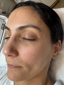 Rita B&A SkinPen-before