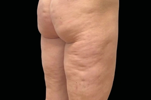 3 Treatments-before