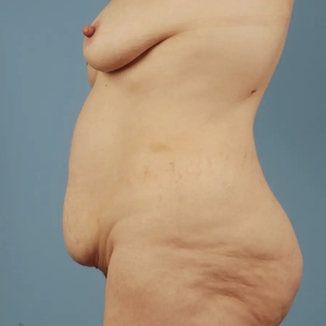 Mommy Makeover #12-before