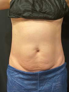 7 weeks post 1st CoolSculpting Treatment-after